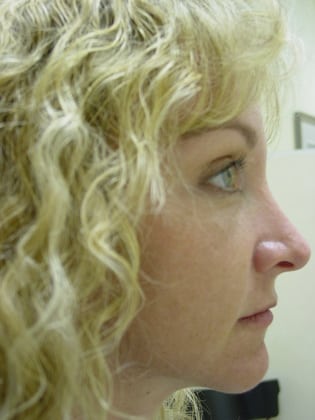 Case--7857 | After Face