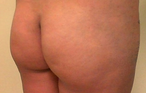 Case--2833 | Before Brazilian Butt Lift