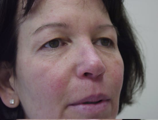 Brow-Lift-Case--7283 | Before Face