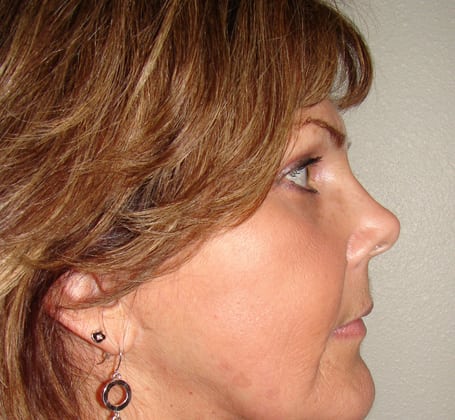 Case--8128 | After Face