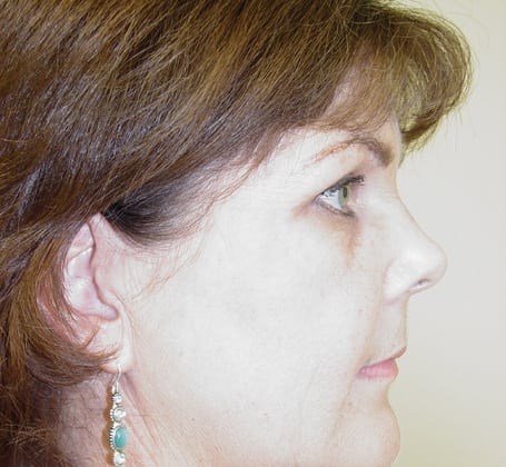 Case--8128 | Before Face