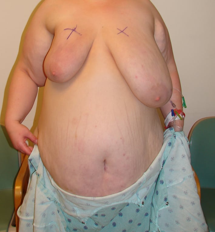 Case--1467 | Before Breast Reduction