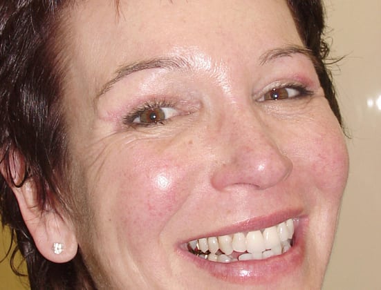 Brow-Lift-Case--7283 | After Face