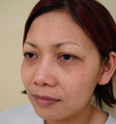 Case--6321 | Before Rhinoplasty