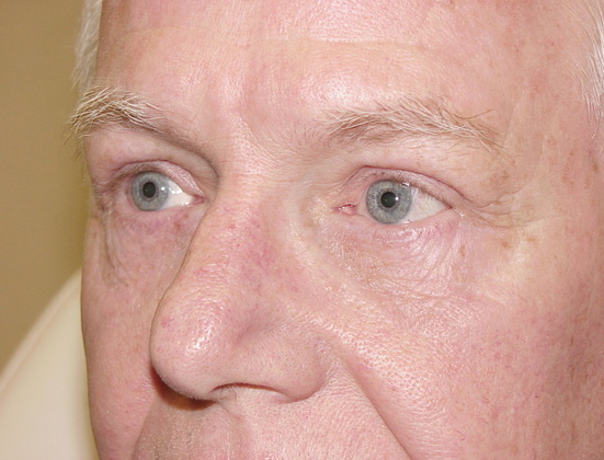 Case--8780 | After Blepharoplasty