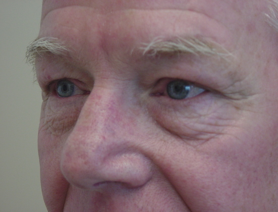 Case--8780 | Before Blepharoplasty