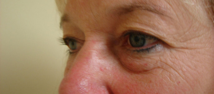 Case--3412 | Before Blepharoplasty