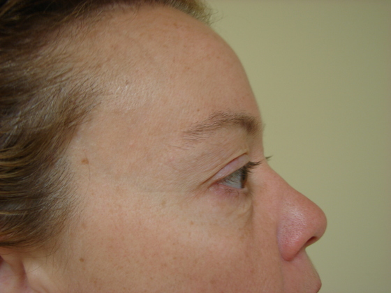 Case--8360 | Before Blepharoplasty
