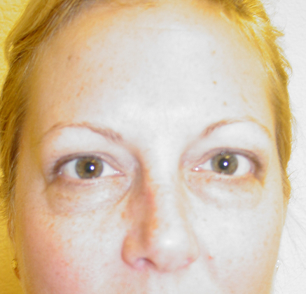 Case--5645 | Before Blepharoplasty