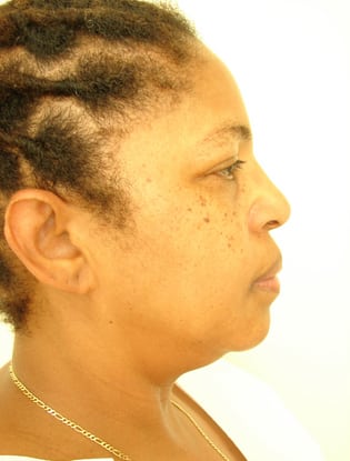 Case--8796 | After Facial Implants