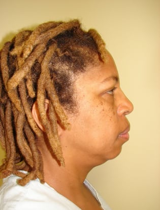 Case--8796 | Before Facial Implants