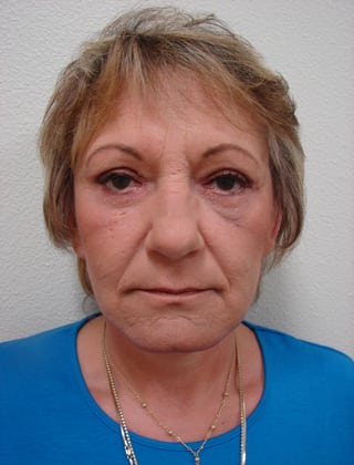 Case--4778 | After Facelift