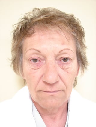 Case--4778 | Before Facelift