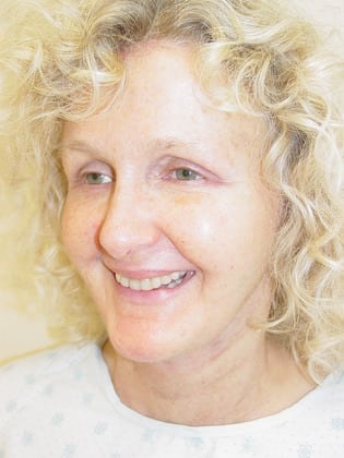 Facelift-Case--9668 | After Facelift