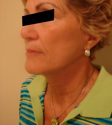 Facelift-Case--7283 | After Facelift