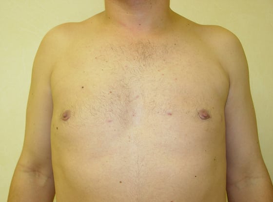 Case--3003 | After Gynecomastia