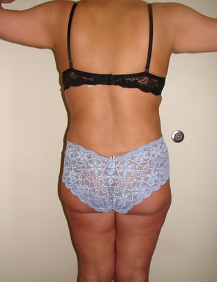 Case--1906 | After Liposuction