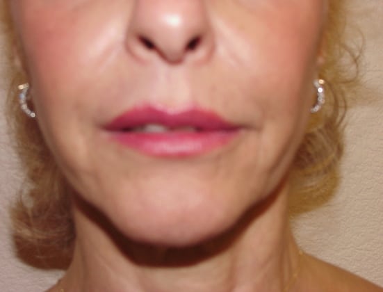 Case--7388 | Before Face