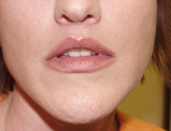 Case--7349 | After Face