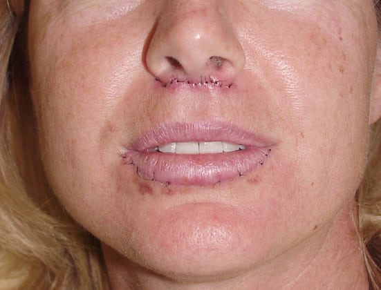 Case--3671 | After Face