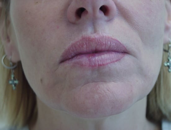 Case--3758 | After Face