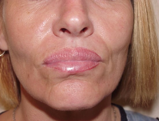 Case--3758 | Before Face