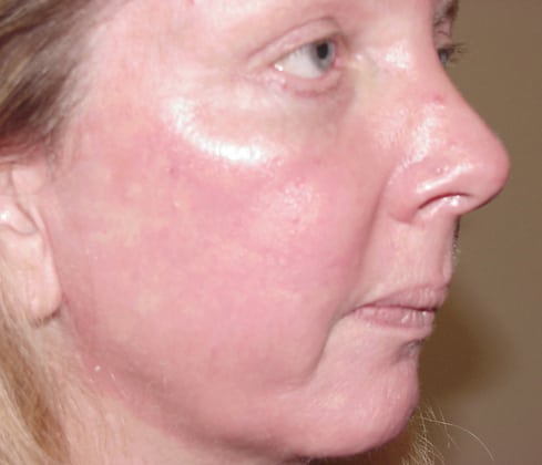Case--8896 | After Laser Resurfacing
