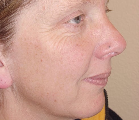 Case--8896 | Before Laser Resurfacing