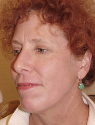 Case--4224 | After Laser Resurfacing