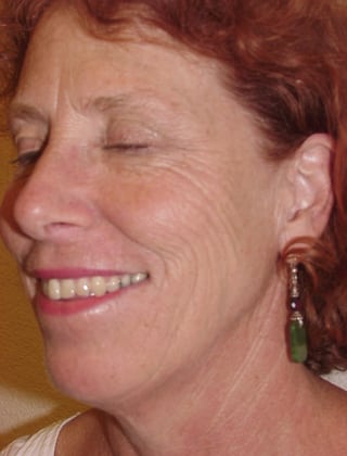 Case--4224 | Before Laser Resurfacing