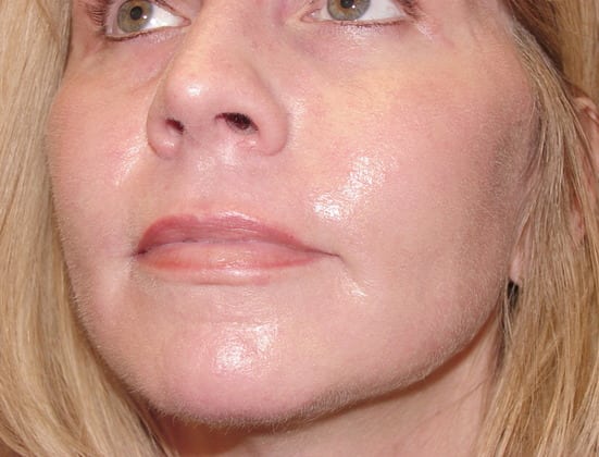 Case--8879 | After Laser Resurfacing