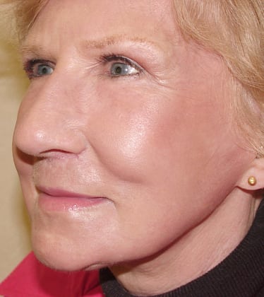 Laser-Resurfacing-Case--2486 | After Laser Resurfacing