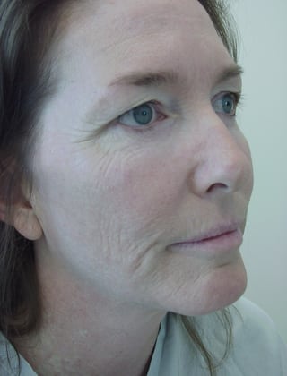 Case--2952 | Before Laser Resurfacing