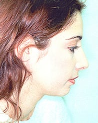 Rhinoplasty-Case--6282 | After Rhinoplasty