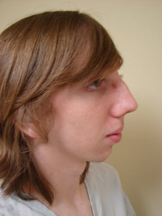 Case--7070 | Before Rhinoplasty