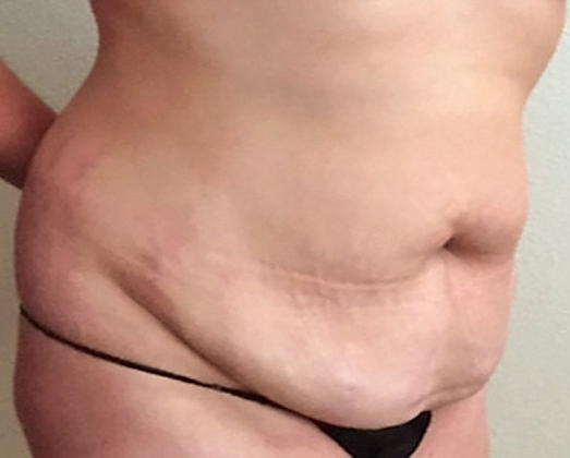 Case--5505 | Before Mommy Makeover