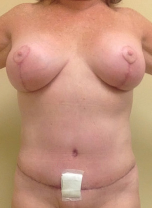 Case--6075 | After Mommy Makeover