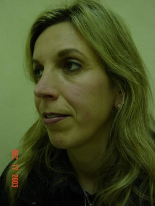 Case--1759 | After Rhinoplasty