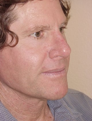Case--5872 | After Rhinoplasty