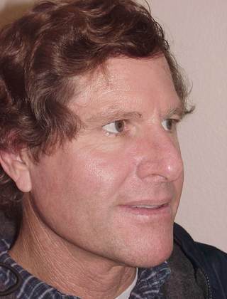 Case--5872 | Before Rhinoplasty