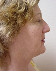 Case--6242 | Before Rhinoplasty