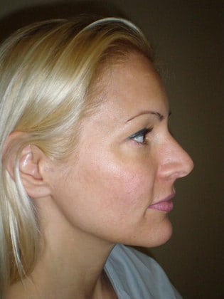 Case--7886 | Before Rhinoplasty