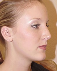 Case--4481 | After Rhinoplasty