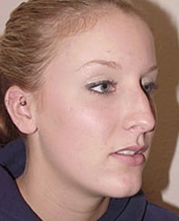 Case--4481 | Before Rhinoplasty