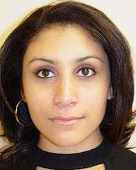 Case--7957 | After Rhinoplasty