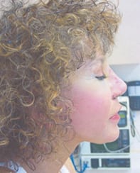 Case--2334 | After Rhinoplasty