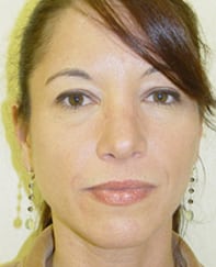 Case--3134 | After Rhinoplasty