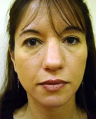 Case--3134 | Before Rhinoplasty