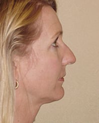 Case--8830 | Before Rhinoplasty