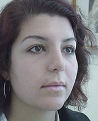 Case--6571 | After Rhinoplasty